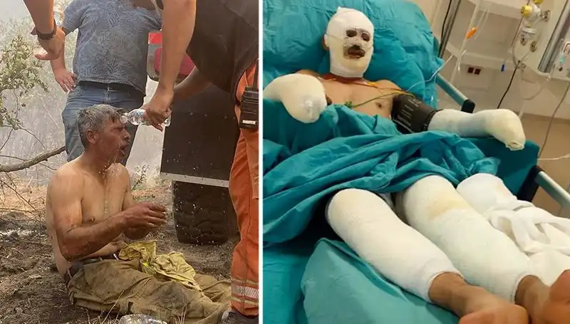 Yanıyorum Diye Feryat Eden Orman İşçisinin Zorlu Tedavi Süreci Başladı